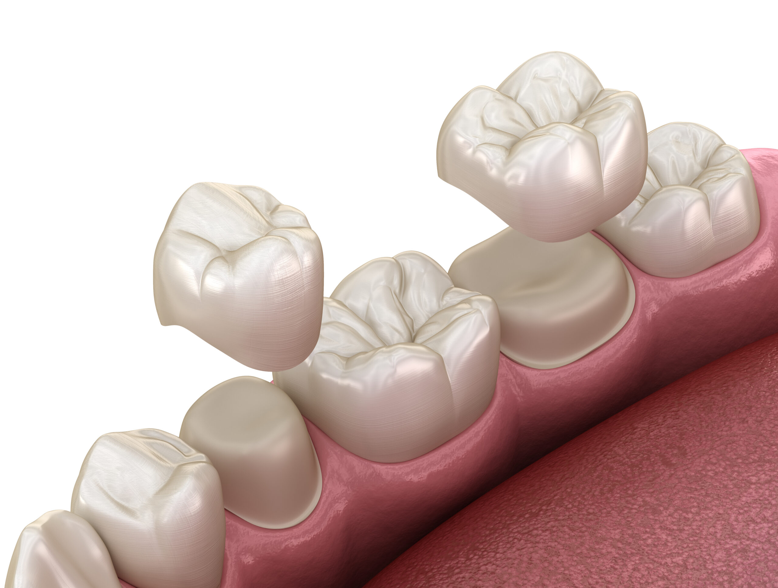 Metal/Porcelain Crown in Playa del Carmen, Mexico by CostaMed Medical Group — Procedure Gallery Photo