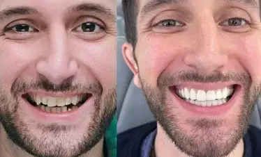 dental crown