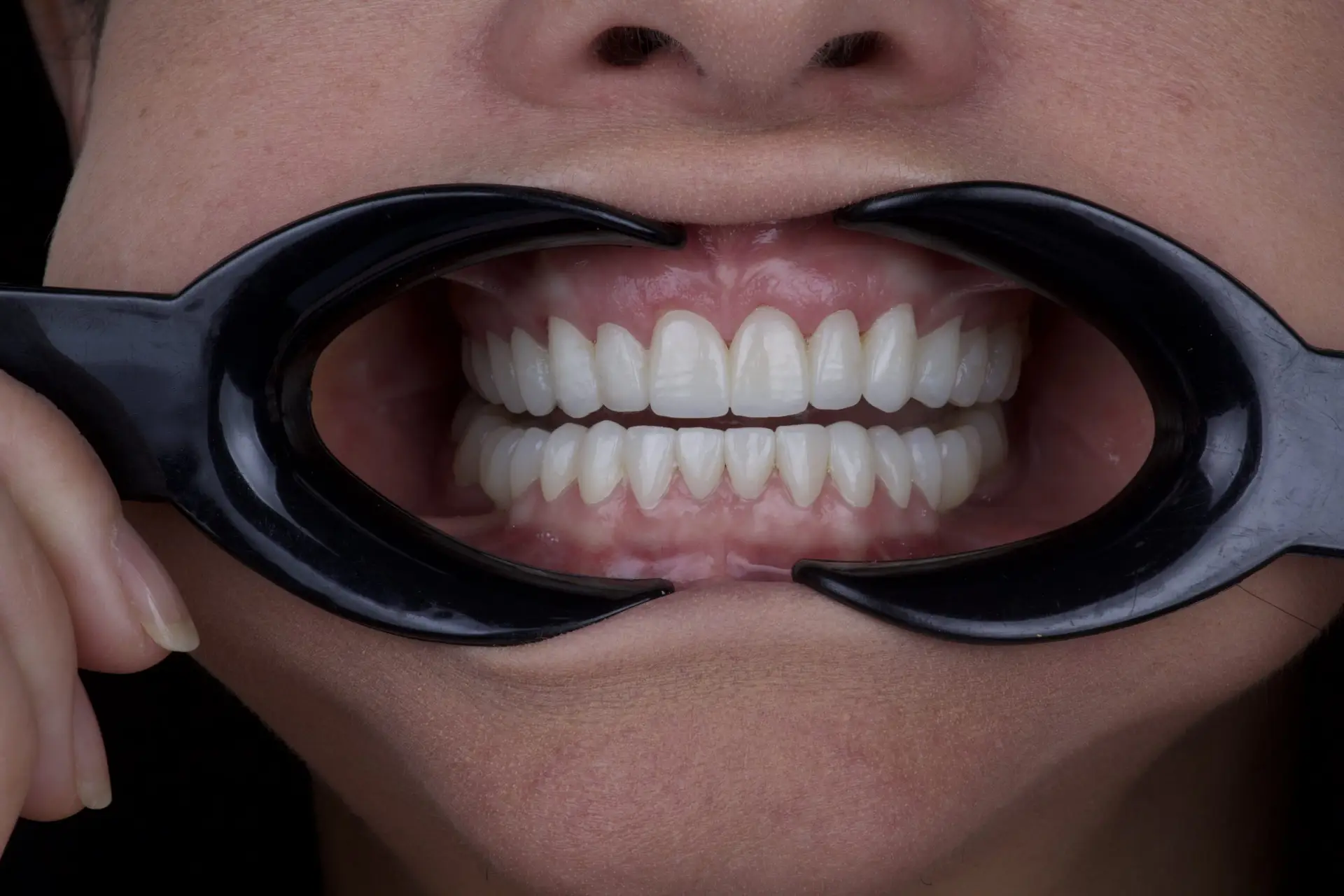 Dental Veneers in San Rafael, Costa Rica by Aesthetic Dental Clinic