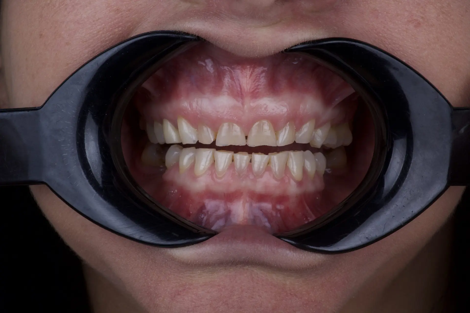 Dental Veneers in San Rafael, Costa Rica by Aesthetic Dental Clinic