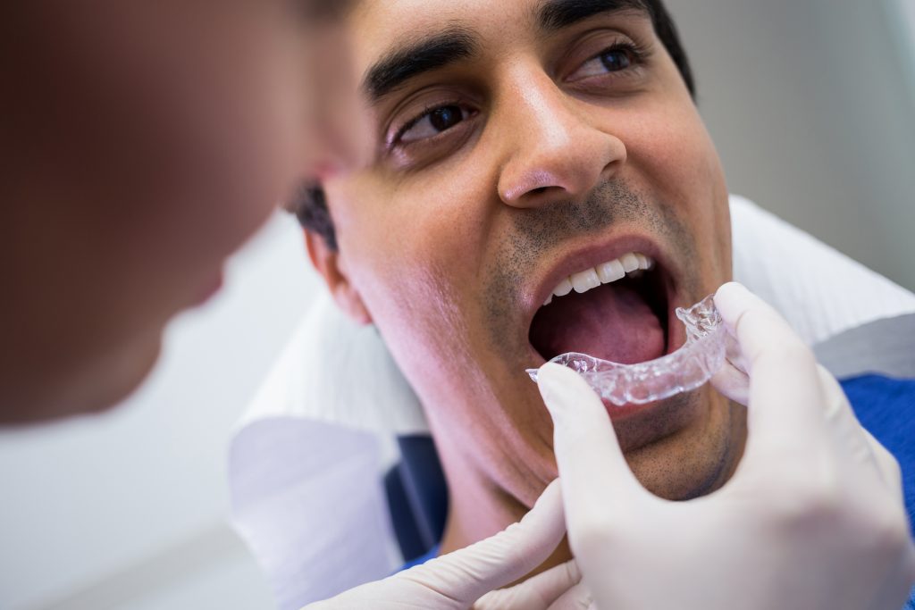 Aligners candidate