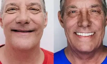 dental implant
