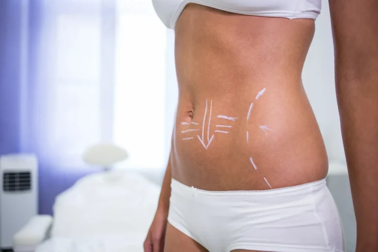 Liposuction in Turkey Cost and Clinics — Liposuction Medical Tourism Guide in Turkey