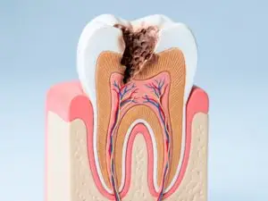 Root Canal in San Rafael, Costa Rica by Aesthetic Dental Clinic — Dentistry in Costa Rica
