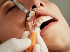 Composite Filling in San Rafael, Costa Rica by Aesthetic Dental Clinic — Dentistry in Costa Rica