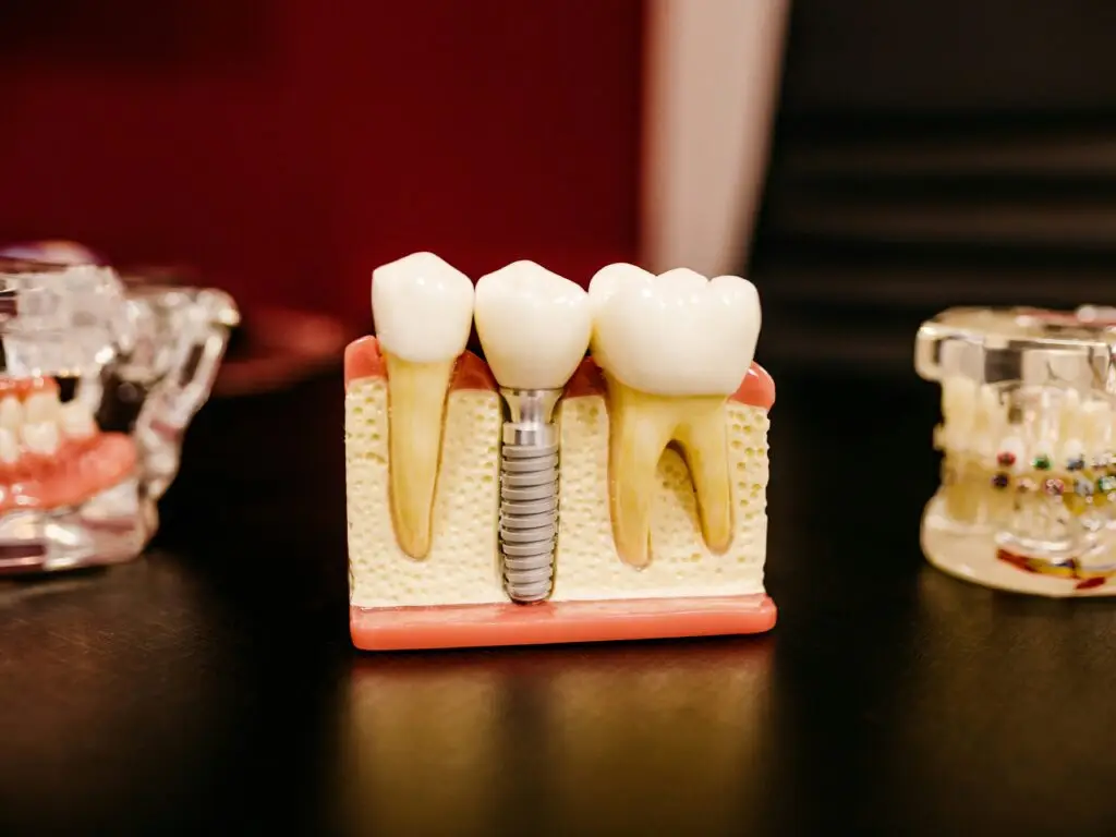 Dental Implants in San Rafael, Costa Rica by Aesthetic Dental Clinic — Dentistry Procedure in Costa Rica