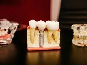 Dental Implants in San Rafael, Costa Rica by Aesthetic Dental Clinic — Dentistry in Costa Rica