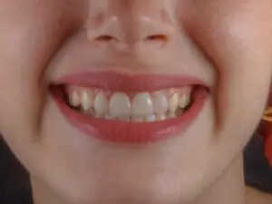 Dental Veneers in San Rafael, Costa Rica by Aesthetic Dental Clinic at Aesthetic Dental Care — Dentistry Procedure Abroad