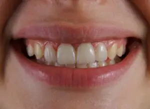Onlay/Inlay in San Rafael, Costa Rica by Aesthetic Dental Clinic at Aesthetic Dental Care — Dentistry Procedure Abroad