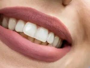 Gingivoplasty (Gum Contouring) in San Rafael, Costa Rica by Aesthetic Dental Clinic at Aesthetic Dental Care — Dentistry Procedure Abroad