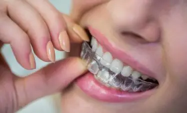 Aligners
