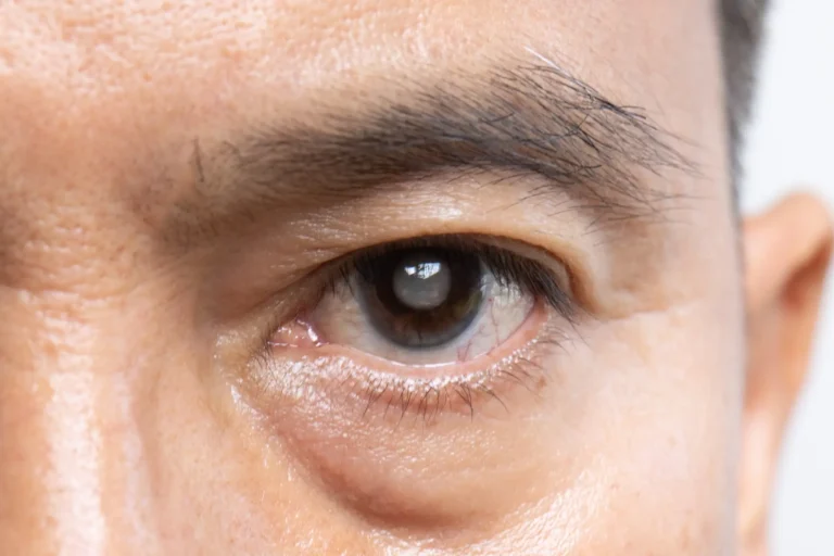 Cataract Surgery in Dubai, United Arab Emirates by Moorfields Eye Hospital — Ophthalmology Procedure in UAE: Dubai