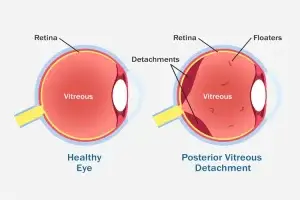 Posterior Vitreous Detachment Clinics and Procedures Abroad
