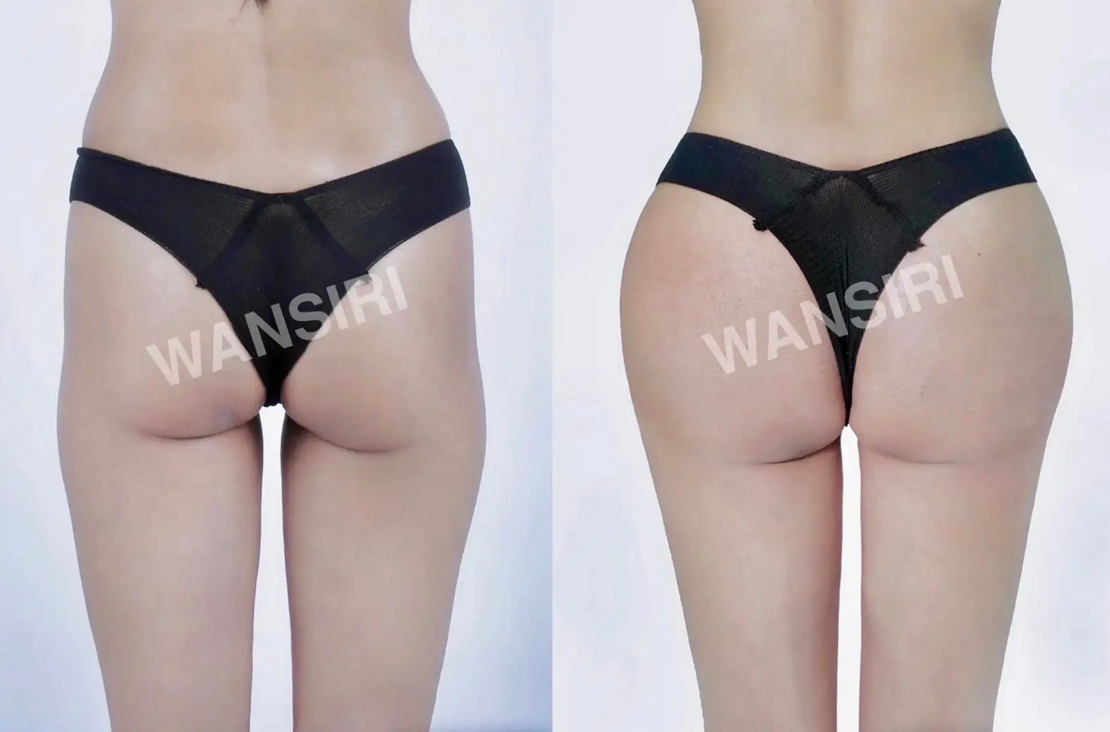 Brazilian Butt Lift in Bangkok, Thailand by Wansiri Hospital