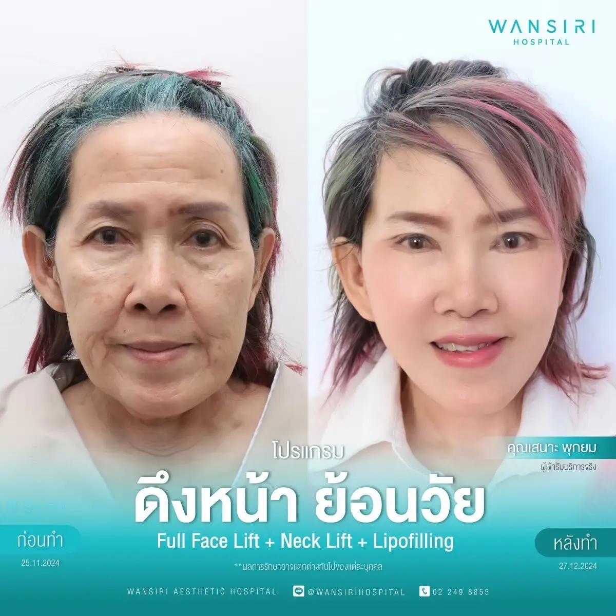 Face Lift in Bangkok, Thailand by Wansiri Hospital