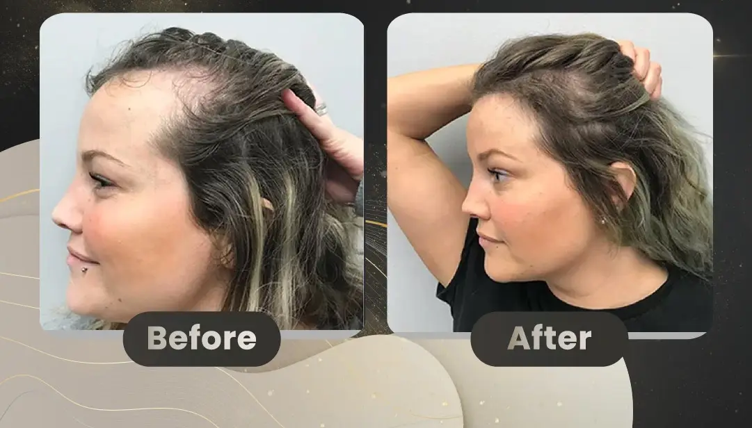 Hair Transplant for Women in Istanbul, Turkey by Memorial Hospital