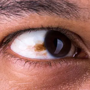 Eye Tumor Treatment Clinics and Procedures Abroad