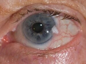 Eye Tumor Treatment in Dubai, United Arab Emirates by Moorfields Eye Hospital at Moorfields Eye Hospital — Ophthalmology Procedure Abroad