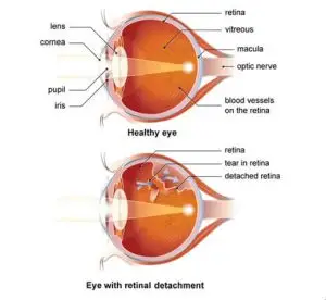 Retinal Detachment Clinics and Procedures Abroad