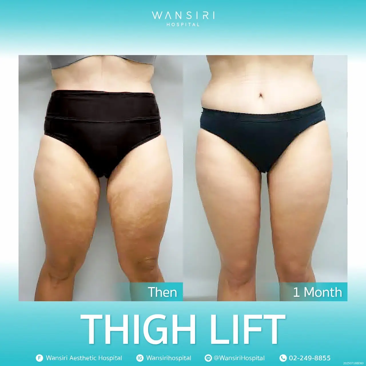 Body Lift in Bangkok, Thailand by Wansiri Hospital