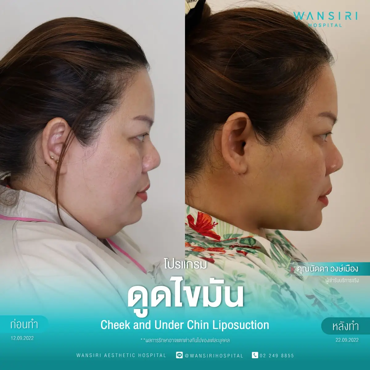 Chin Augmentation in Bangkok, Thailand by Wansiri Hospital