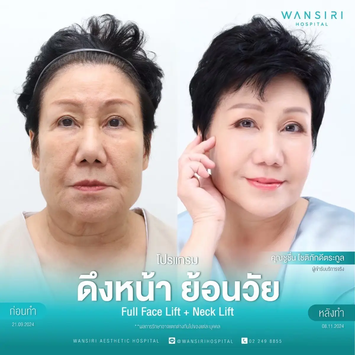 Face Lift in Bangkok, Thailand by Wansiri Hospital