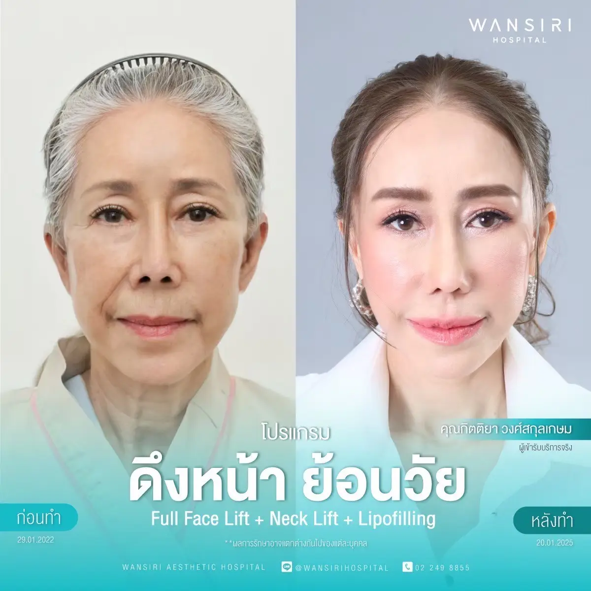 Face Lift in Bangkok, Thailand by Wansiri Hospital