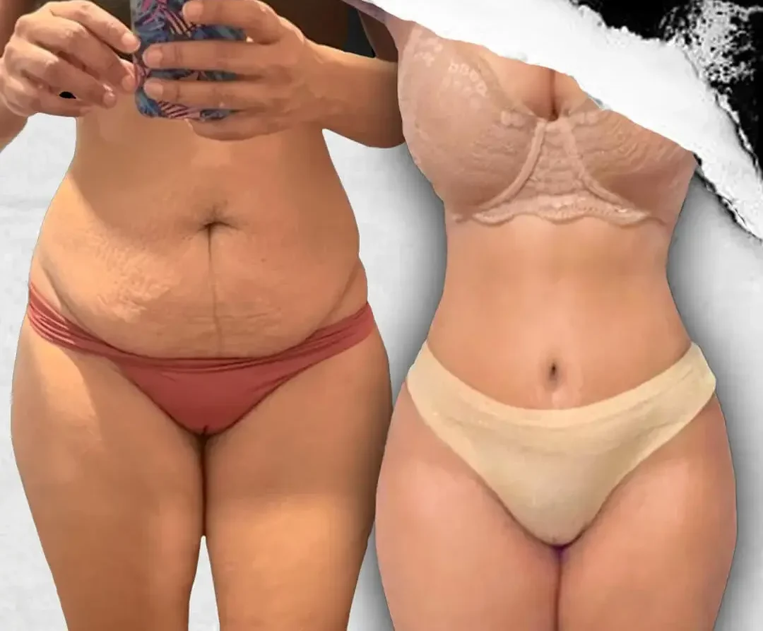 Tummy Tuck (Abdominoplasty) in Istanbul, Turkey by International Plus