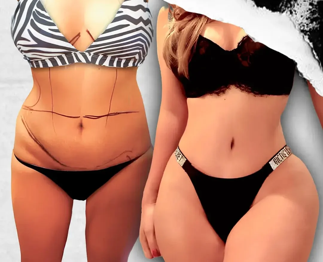 Tummy Tuck (Abdominoplasty) in Istanbul, Turkey by International Plus