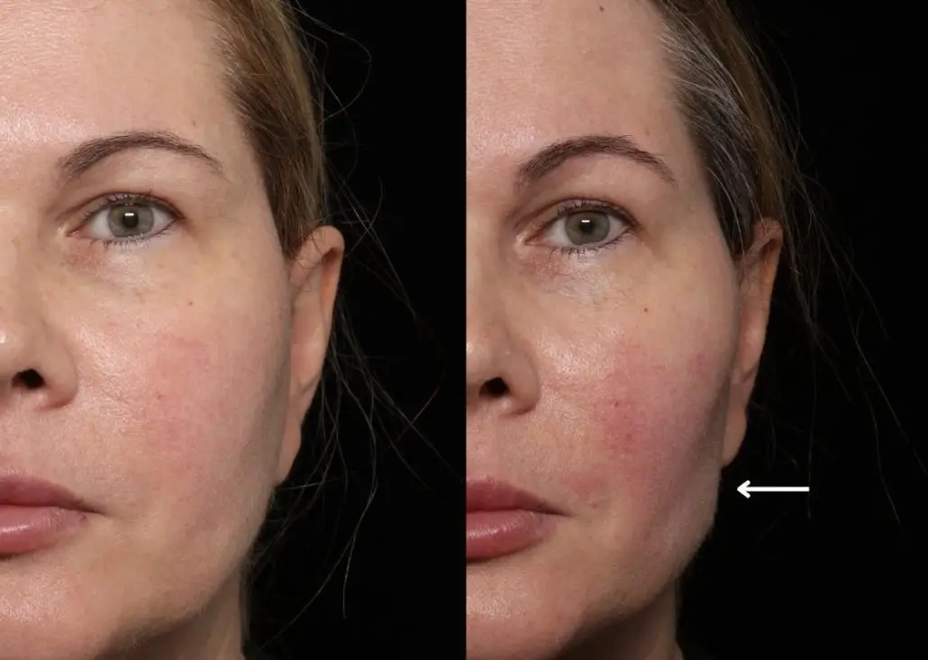Bichectomy (Buccal Fat Removal) in Playa del Carmen, Mexico by CostaMed Medical Group — Procedure Gallery Photo