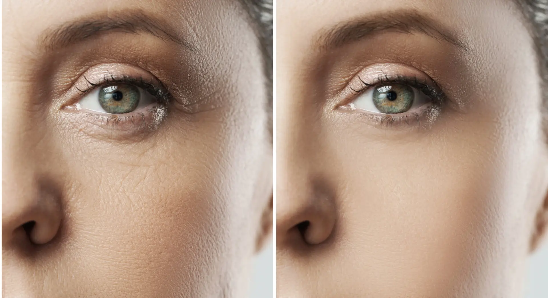 Blepharoplasty in Istanbul, Turkey by Memorial Hospital