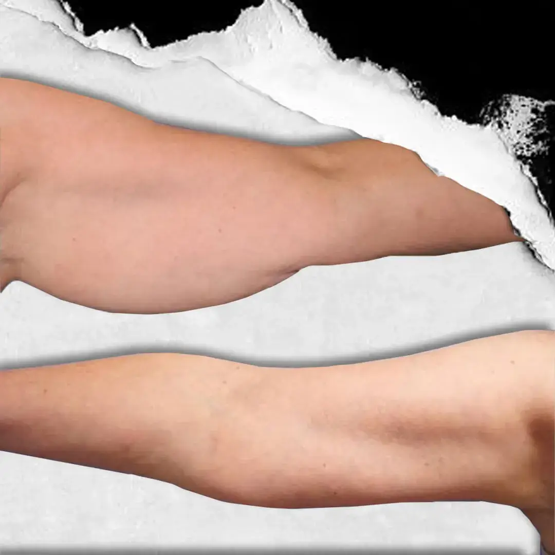 Brachioplasty (Arm Lift) in Istanbul, Turkey by International Plus — Procedure Gallery Photo