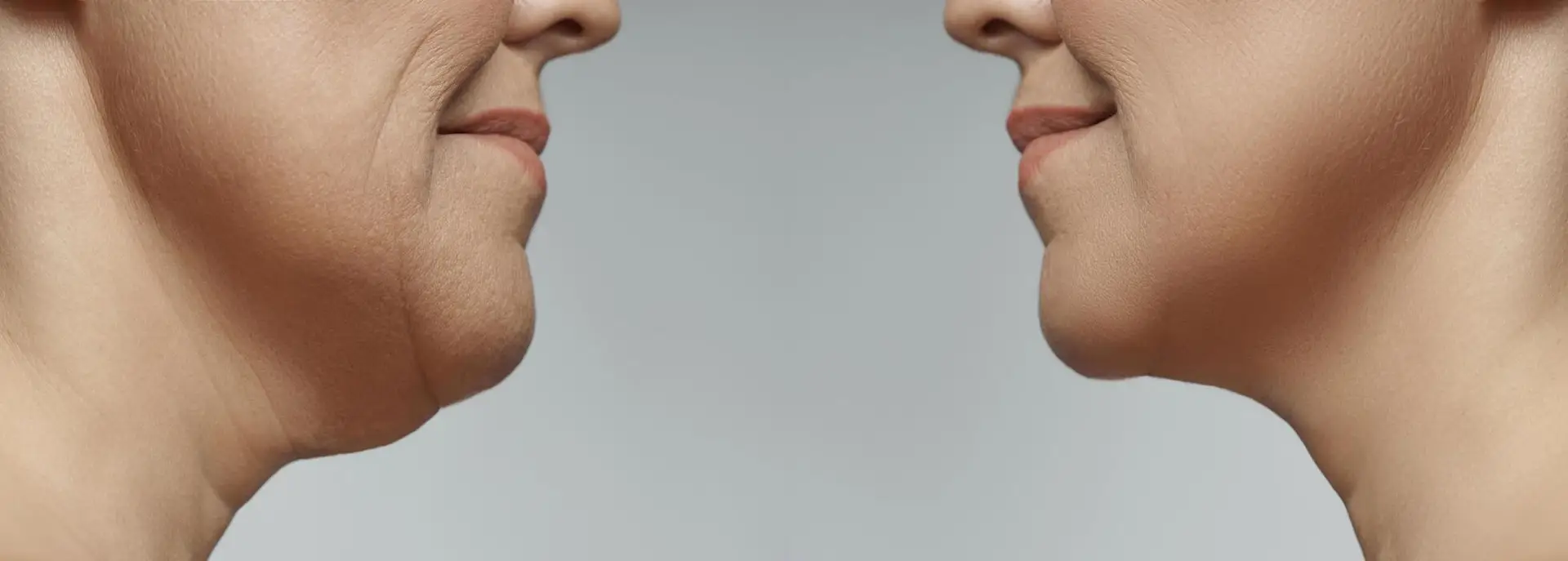 Double Chin Treatment in Istanbul, Turkey by International Plus