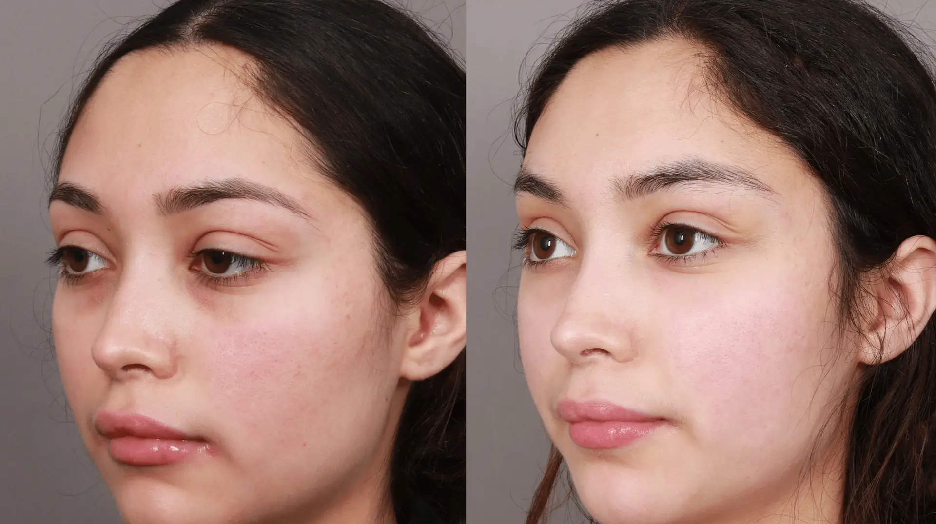 Eyebrow Lift in Istanbul, Turkey by Memorial Hospital