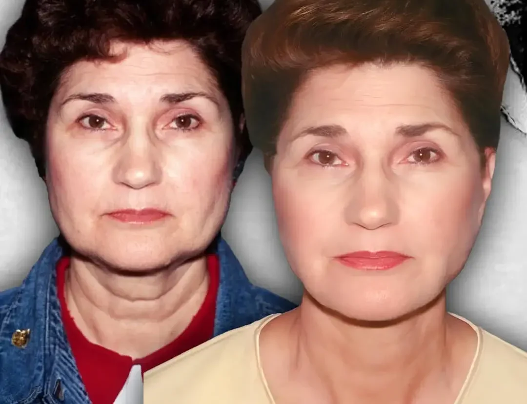 Face Lift in Istanbul, Turkey by International Plus