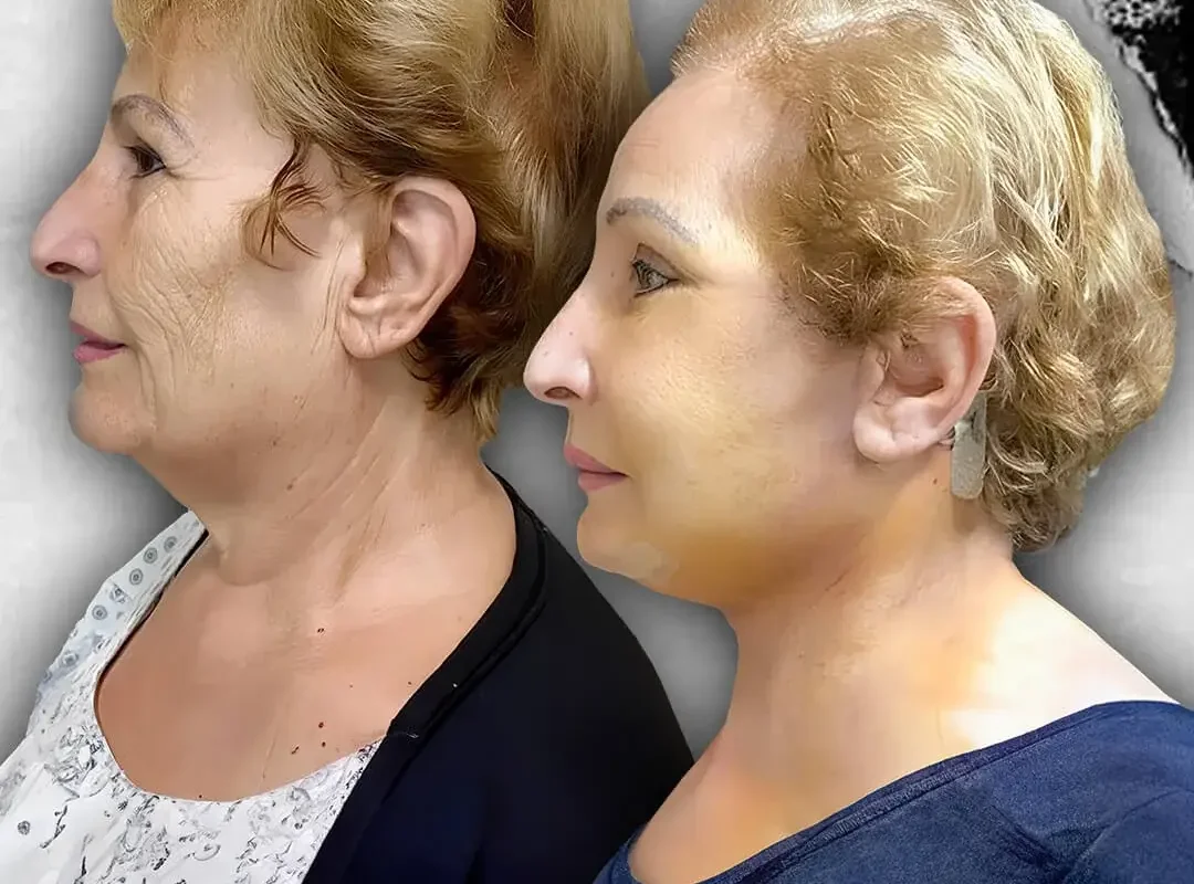 Face Lift in Istanbul, Turkey by International Plus