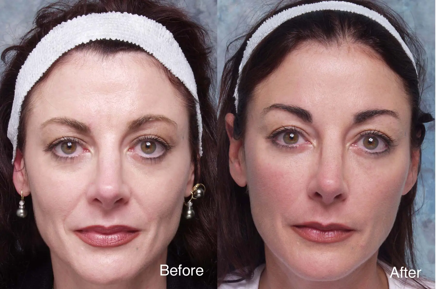 Forehead Lift in Istanbul, Turkey by Memorial Hospital