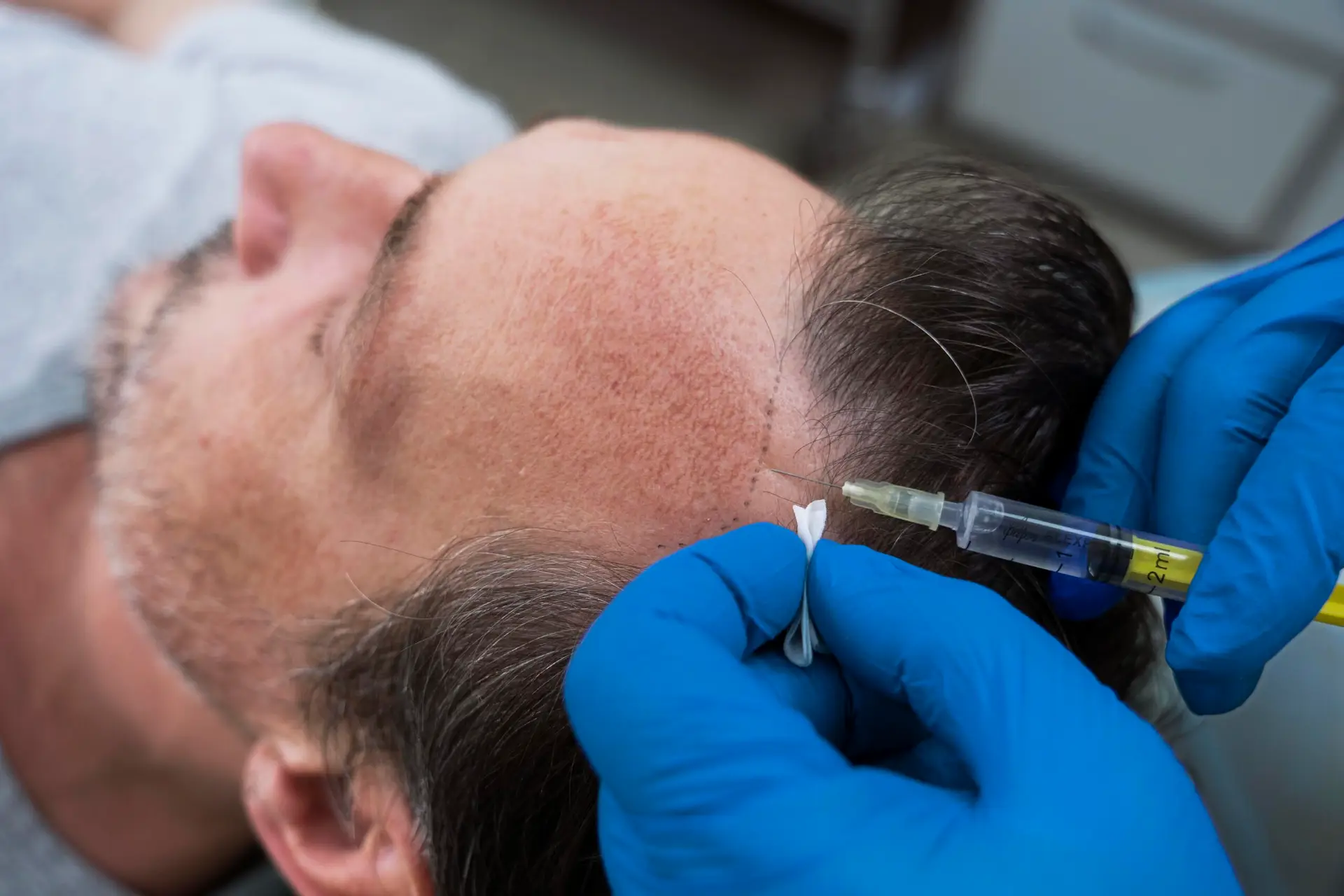 Stem Cell Hair Transplant in Istanbul, Turkey by Memorial Hospital — Procedure Gallery Photo