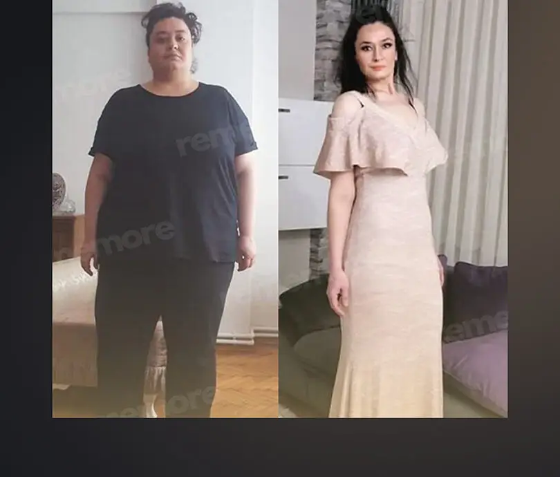 Gastric Balloon in Istanbul, Turkey by Memorial Hospital — Procedure Gallery Photo