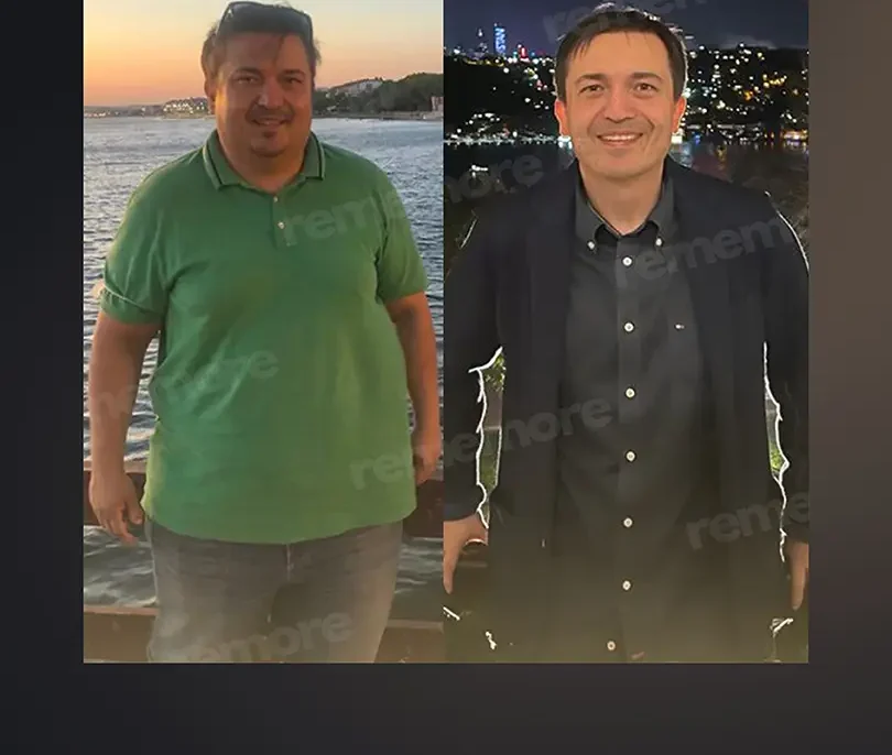 Endoscopic Sleeve Gastroplasty (ESG) in Istanbul, Turkey by Memorial Hospital