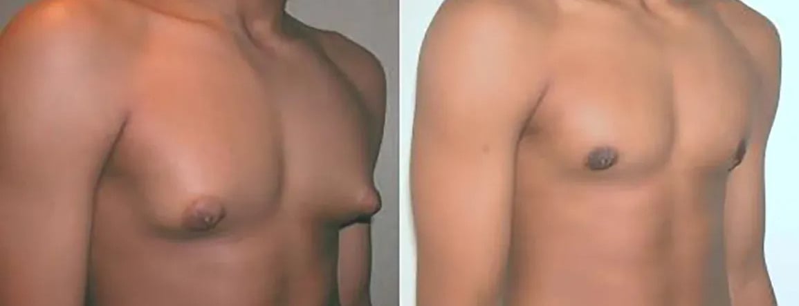 Gynecomastiain in Istanbul, Turkey by Memorial Hospital