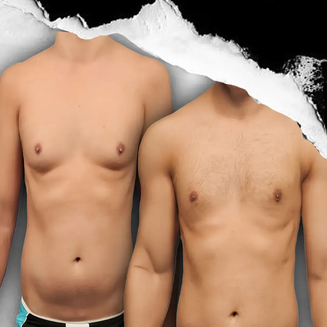 Gynecomastia in Istanbul, Turkey by International Plus