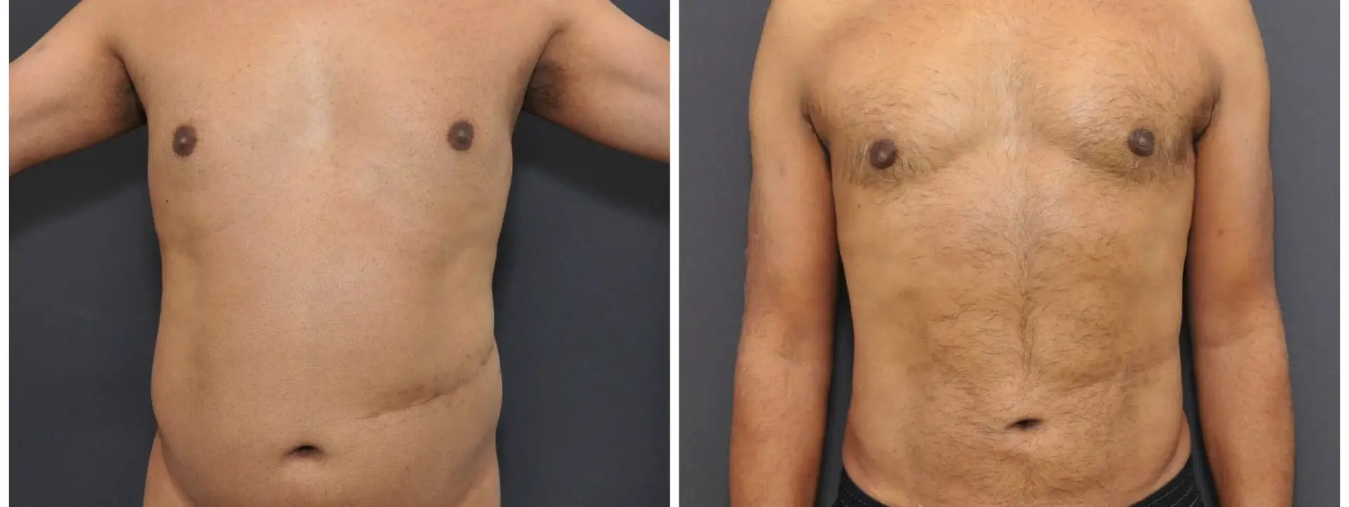 Liposuction in Istanbul, Turkey by Memorial Hospital