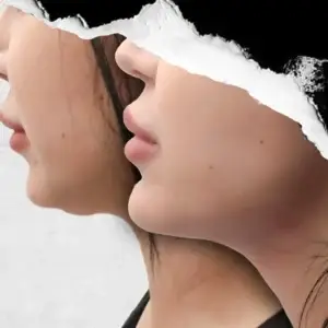 Neck Lift in Istanbul, Turkey by International Plus