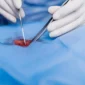 Pilonidal Cyst Surgery Cost Without Insurance