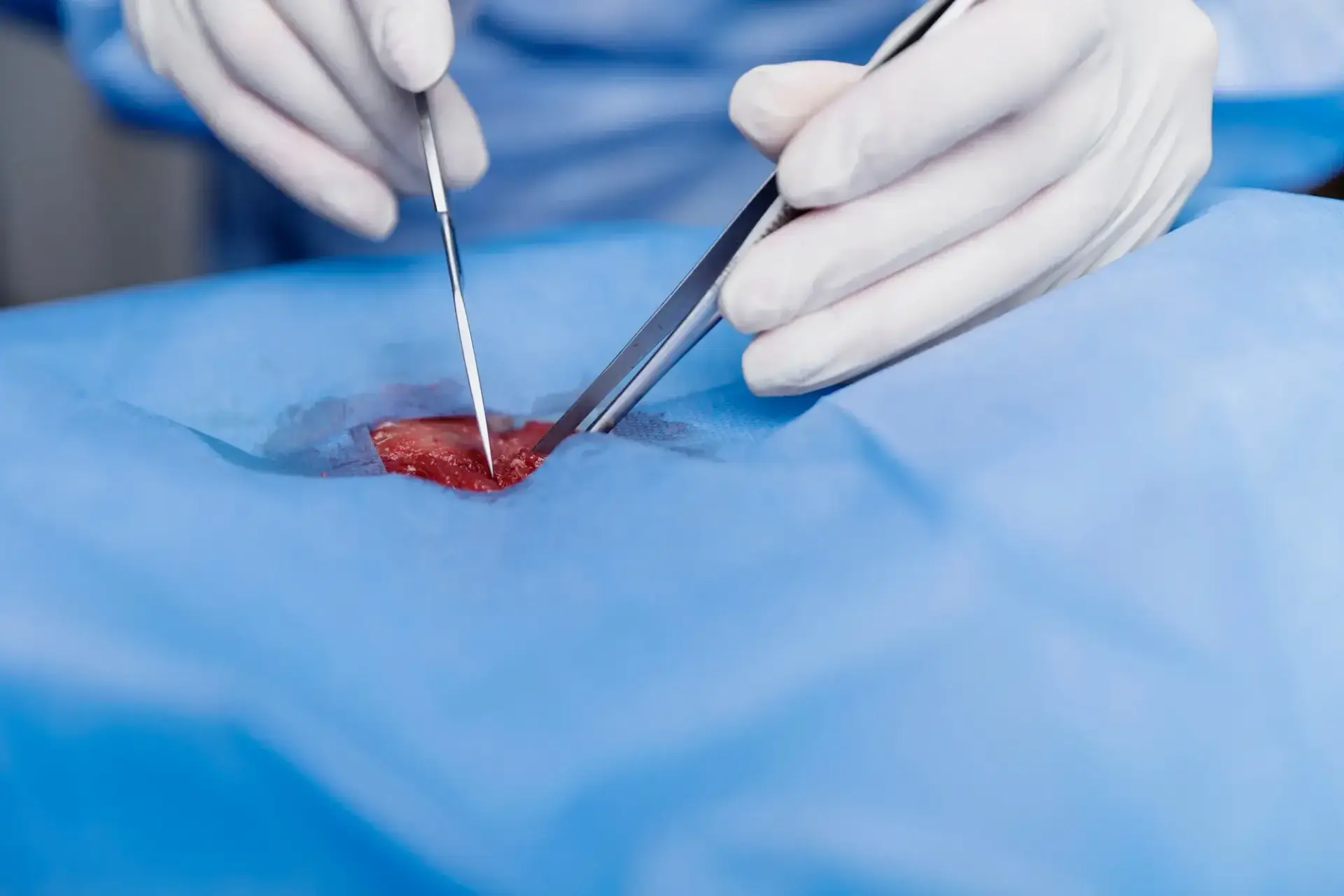 Pilonidal Cyst Surgery Cost Without Insurance