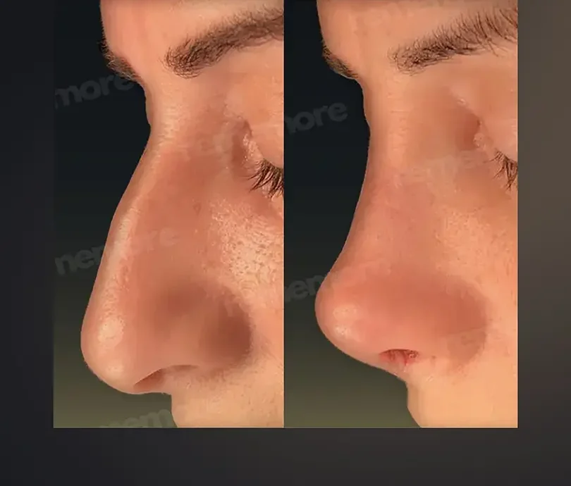 Rhinoplasty in Istanbul, Turkey by Memorial Hospital