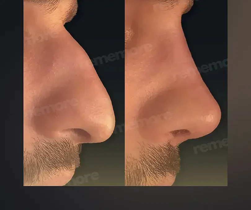 Rhinoplasty in Istanbul, Turkey by Memorial Hospital