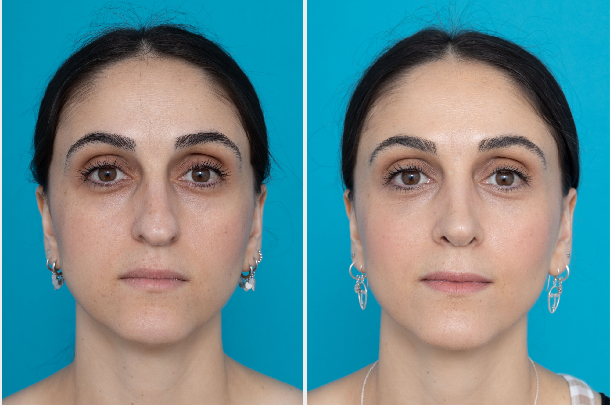 Rhinoplasty in Playa del Carmen, Mexico by CostaMed Medical Group