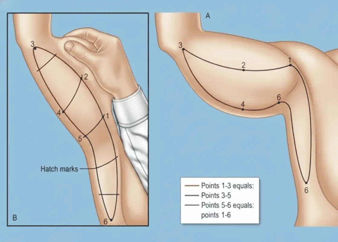Arm Lift in Bangkok, Thailand by Wansiri Hospital